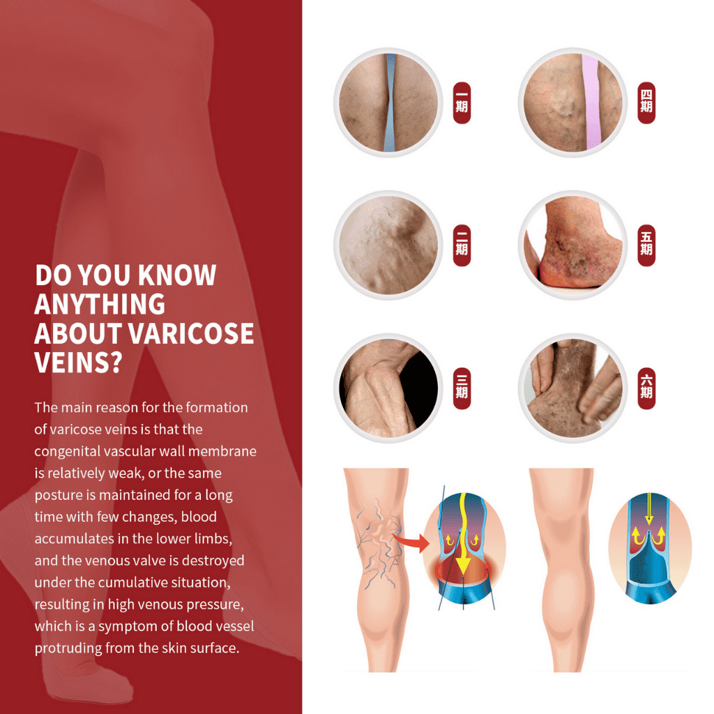 Varicose veins crema para varices - ESDealmania